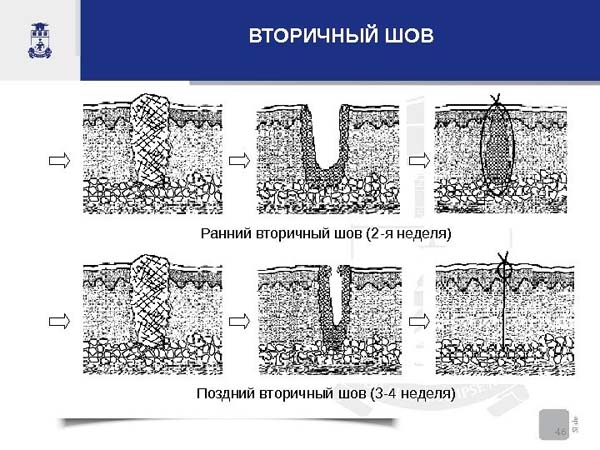 Как выглядит грануляция раны фото